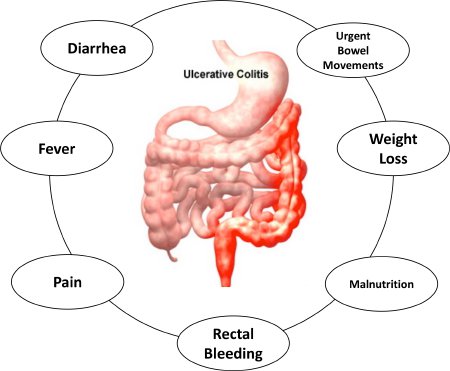 UC Symptoms